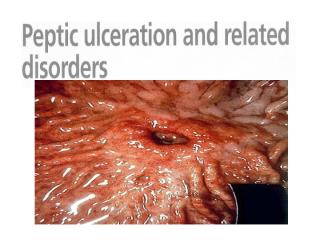 Peptic ulcer.pptx
